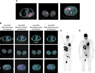 Case Report: Adult NTRK-Rearranged Spindle Cell Neoplasm: Early Tumor Shrinkage in a Case With Bone and Visceral Metastases Treated With Targeted Therapy